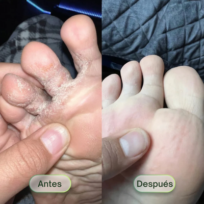 Saniverde ® Jabón Antifúngico (PIED)
