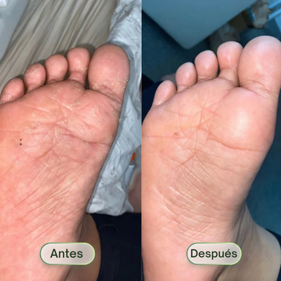 Saniverde ® Jabón Antifúngico (PIED)