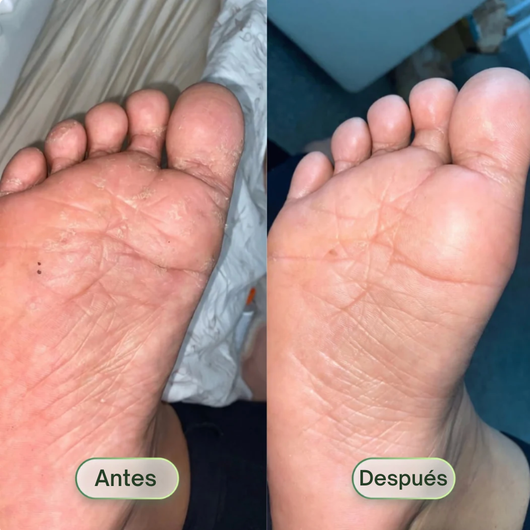 Saniverde ® Jabón Antifúngico (PIED)